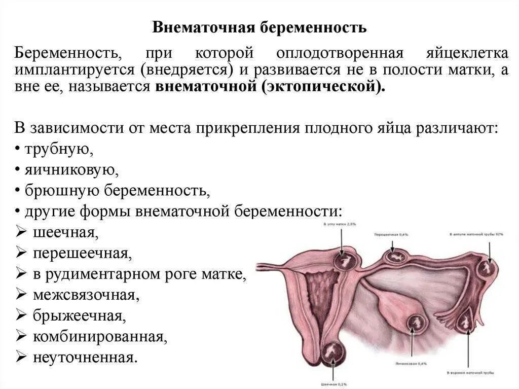 Внематочная беременность можно сохранить. Внематочная беременность Трубная беременность. Причина трубной внематочной беременности. Клинические симптомы внематочной беременности. Беременность эктопическая – внематочная беременность..