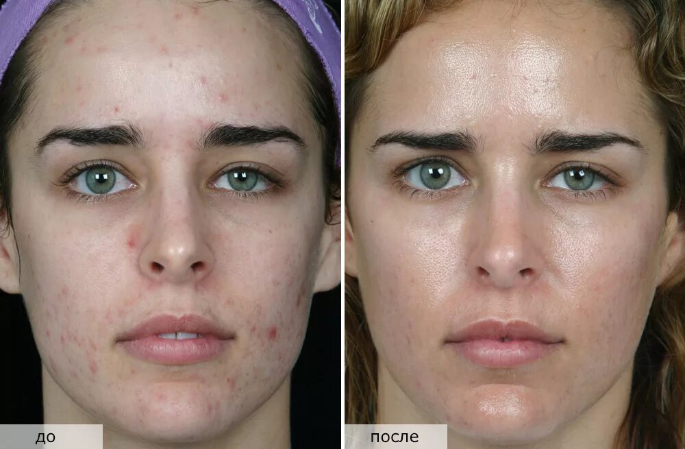Последствия процедуры. Дезинкрустация (гальваническая чистка лица). Кожа до и после косметолога. Механическая чистки лица жо и после.