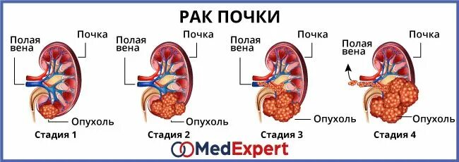 Новообразование 4 степени почки. Размеры опухолей почек по стадиям. Есть ли рак почки