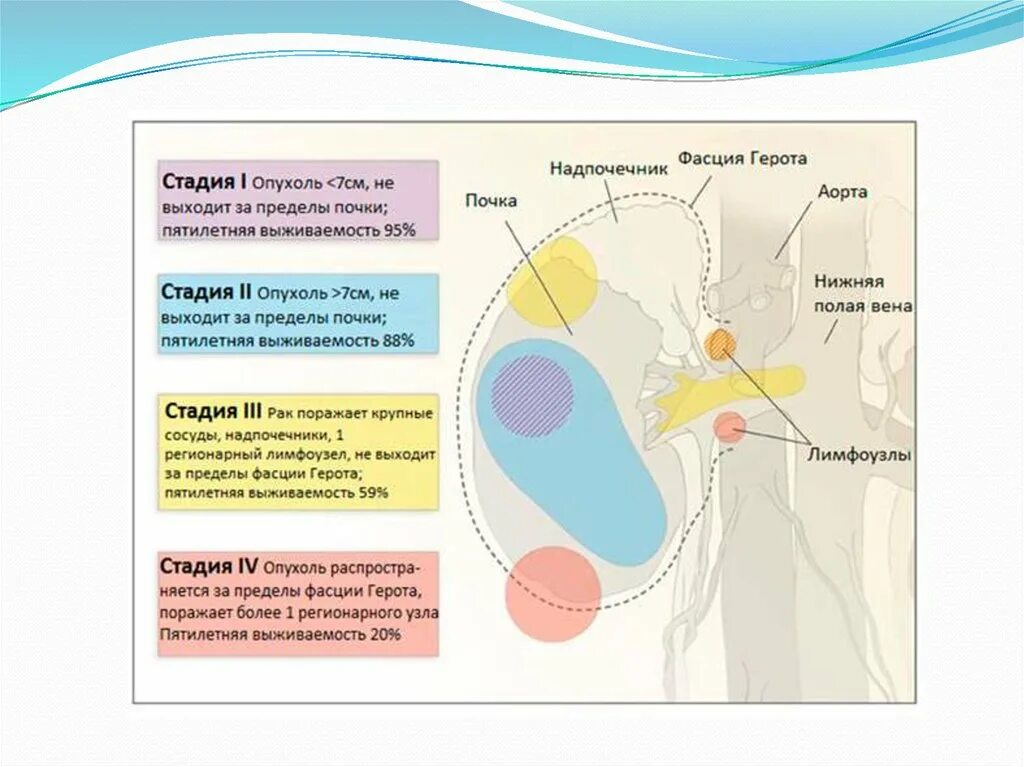 Рак почки выживаемость. Фасция Герота почки что это. Презентация на тему опухоли почек. Фасция Герота на кт. Стадии распространения опухоли почки.