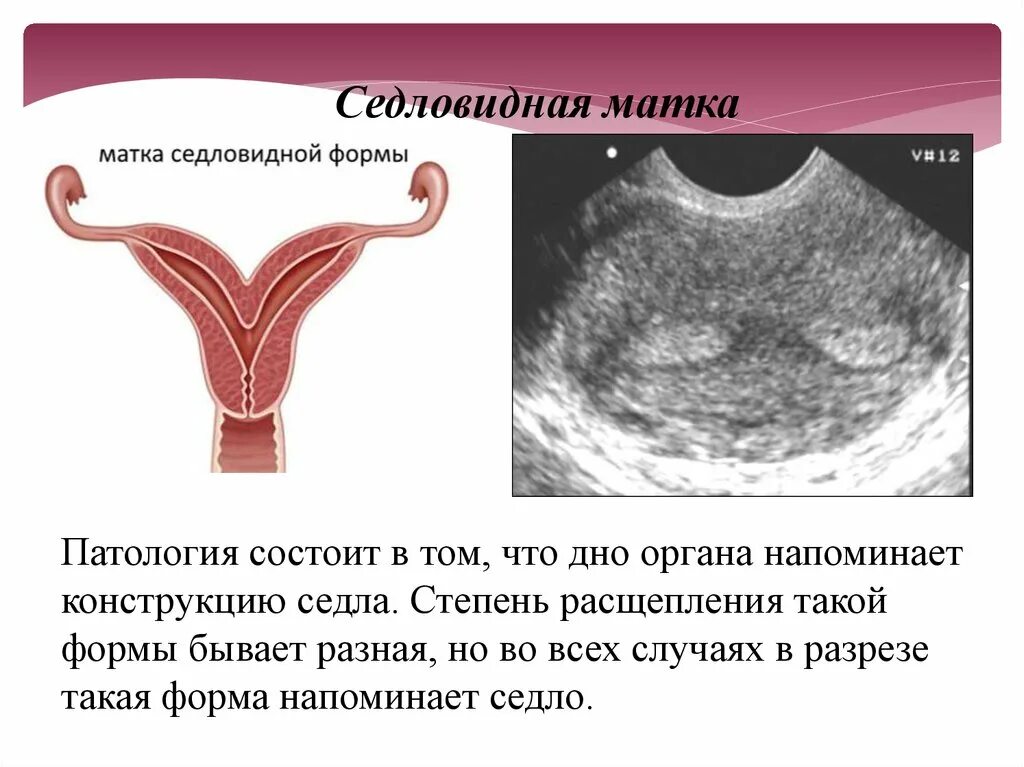 Матка 37 мм. Двурогая матка грушевидная. Форма матки седловидная грушевидная. Двурогая седловидная матка. Формы матки двурогая матка.