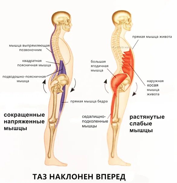 Длин поясница. Гиперлордоз поясничного. Перекос таза. Искривление позвоночника гиперлордоз. Подвздошно-поясничная мышца и гиперлордоз.