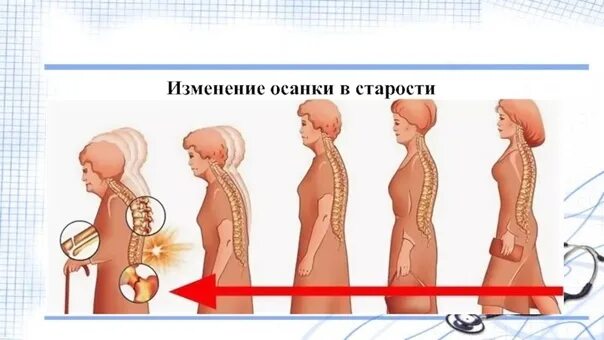 Изменения связанные с возрастом. Изменение осанки. Изменение осанки с возрастом. Старение осанка. Осанка и Возраст.