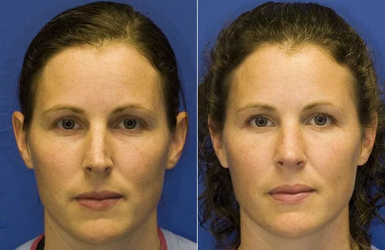 исправление кривой перегородки носа. исправление кривого носа. кривой нос одна сторона. кривой нос одна сторона. исправление асстметрии носа.