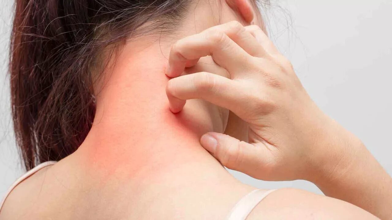 Аллергический дерматит на шее. Аллергия экзема на шее.