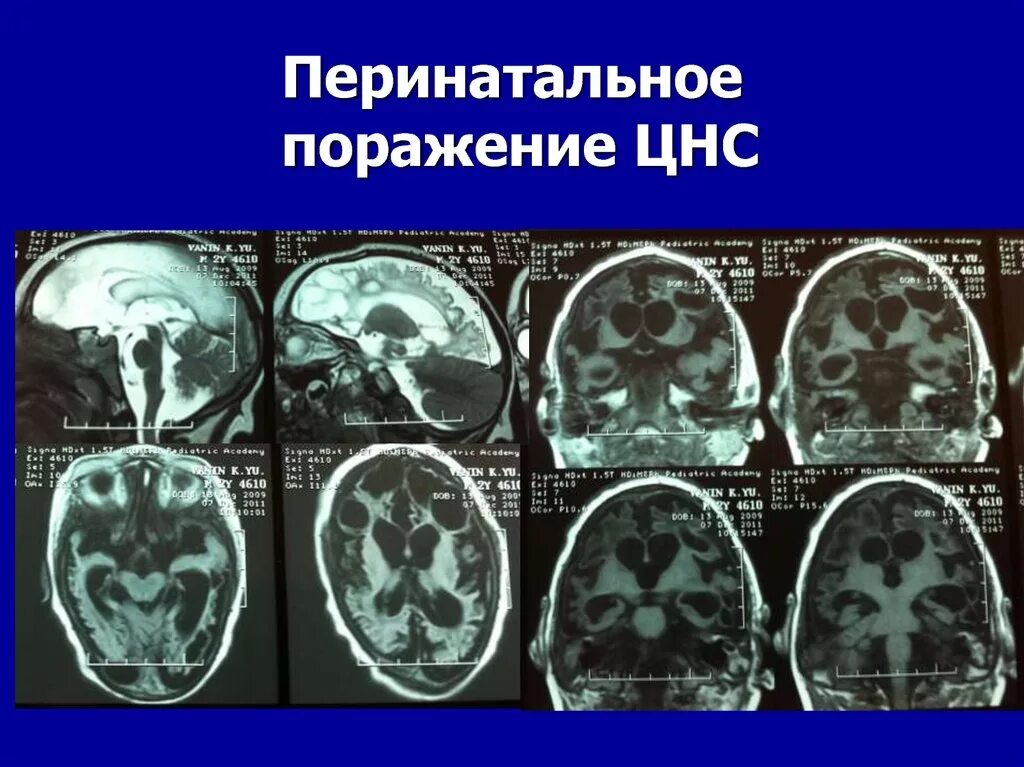 Поражение головного мозга последствия. Перинатальное поражение головного мозга. Перинатальное повреждение ЦНС. Внутриутробное поражение нервной системы. Перинатальное поражение нервной системы у детей.