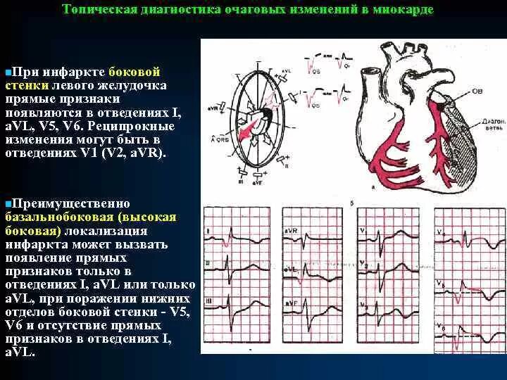 Изменения миокарда левого желудочка на ЭКГ. Инфаркт миокарда переднебоковой стенки. Миокарда боковой стенки ЭКГ. Инфаркт передней стенки на ЭКГ. Изменение боковой стенки левого желудочка