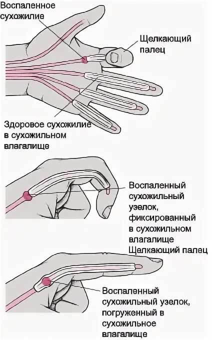 Стенозирующий лигаментит щелкающий палец. Щелкающий 1 палец кисти операция. Болезнь Нотта щелкающий палец. Щелчок при сгибании большого пальца руки. Болит и щелкает большой палец на руке