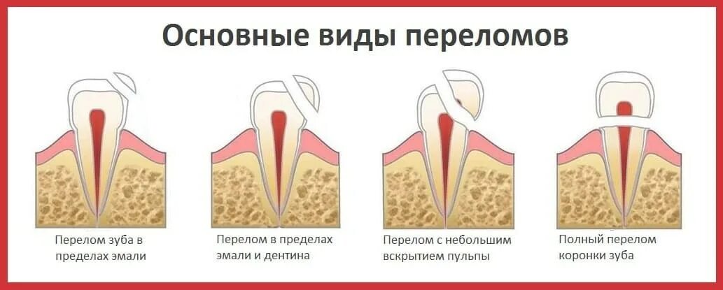 Трещина заднего зажила. Перелом корня зуба классификация. Перелом коронки классификация. Коронково-корневой перелом зуба.