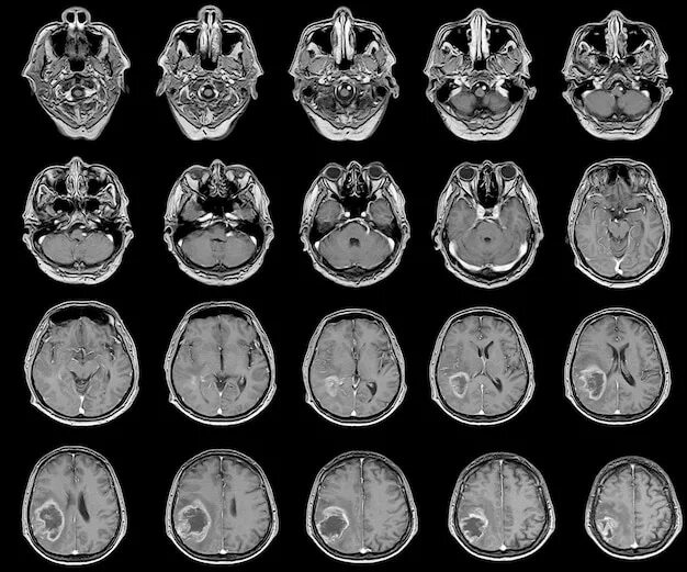 Патологии на мрт. Опухоль головного мозга снимок мрт. Глиома головного мозга мрт. Магнитно резонансные томограммы головного мозга. Снимок головного мозга с опухолью на РКТ.