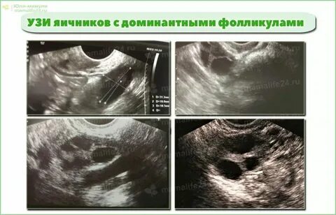 Антральные фолликулы что это