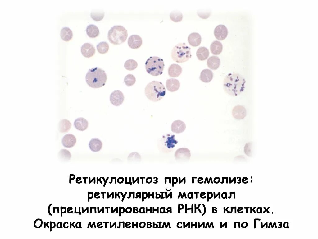 Повышение ретикулоцитов в крови. Окраска ретикулоцитов по Романовскому. Ретикулоциты окраска по Романовскому Гимзе. Ретикулоцитоз при. Ретикулоциты клетки.