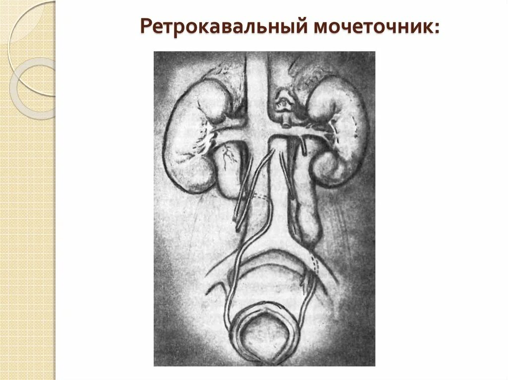 Интрамуральный мочеточник. Аномалии развития мочеточников 1 мочеточник. Ретроилиакальный мочеточник. Ретрокавальный мочеточник. Пороки мочевыделительной системы.