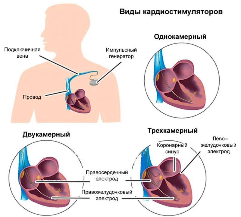 Кардиостимулятор сердца установка пожилым плюсы и минусы. Кардиостимулятор сердца установка пожилым плюсы и минусы. Кардиостимулятор биотроник двухкамерный. Вилы электрокардиостимуляторов. Противопоказания к имплантации электрокардиостимулятора.