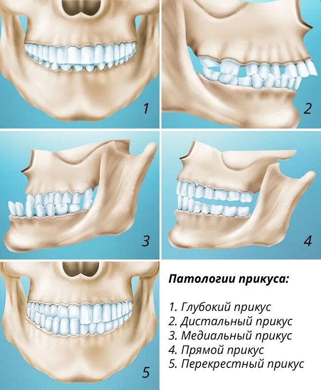 Зубы при закрытом рте. Правильное расположение челюсти сбоку. Дистальный (прогнатический) прикус. Прикус неправильный нижней челюсти зубов. Неправильный дистальный глубокий прикус.