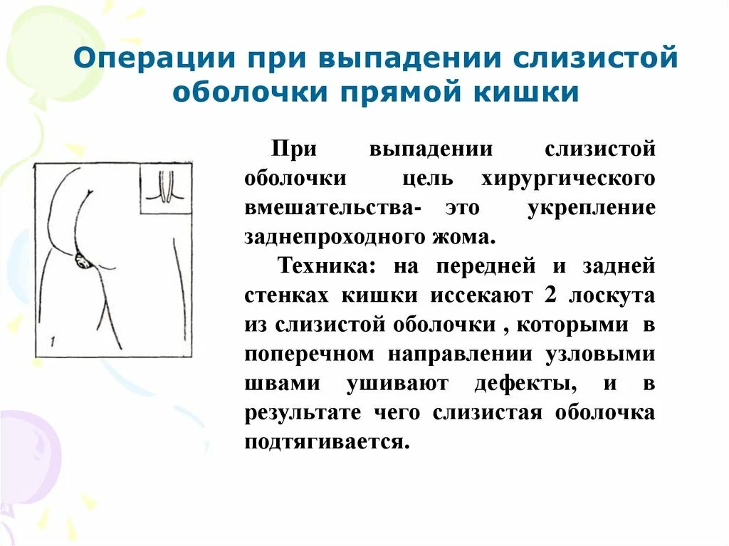 Выпадение слизистой оболочки прямой кишки. Операции выполняемые при выпадении прямой кишки. Выпадение прямой кишки у детей.