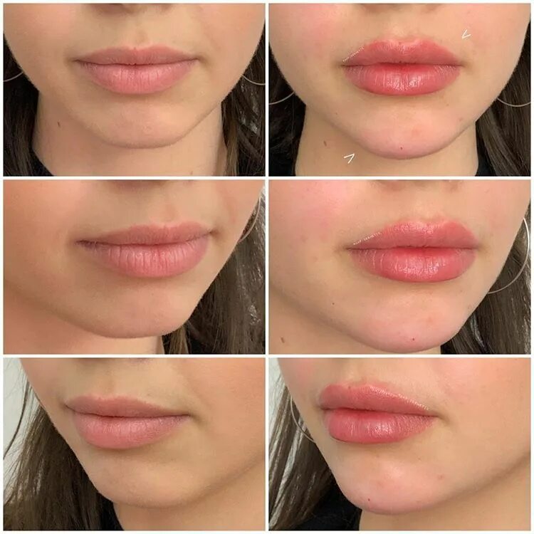 Увеличение губ lips. Форма губ для увеличения. Естественное увеличение губ.