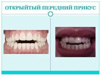 Передний прикус