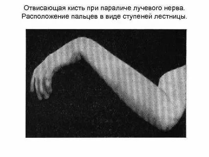 Парез руки
