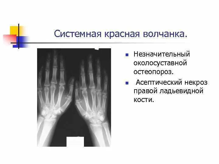 Поражение суставов при системной красной волчанке. Системная красная волчанка рентген кистей. Рентген суставов при системной красной волчанке. Красная волчанка ревматоидный артрит