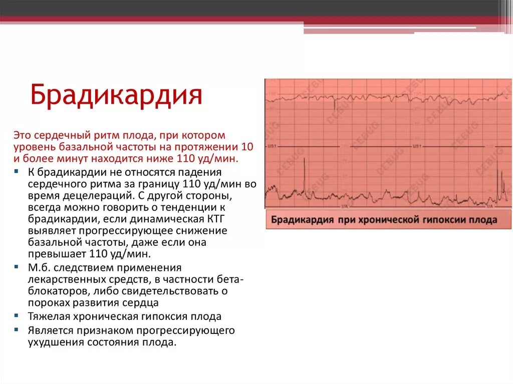 Сердцебиение 14 недель. Брадикардия. Брадикардия плода. Синусовая брадикардия у плода. Брадикардия сердца у плода.