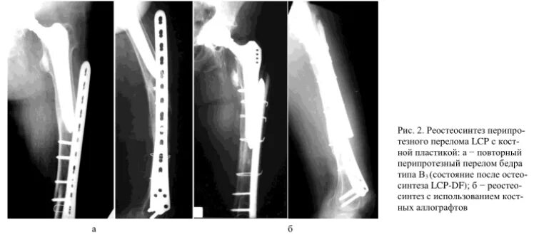 Перелом шейки бедра операция эндопротез. Перелом после эндопротезирования тазобедренного сустава. Тотальное цементное эндопротезирование тазобедренного сустава. Перелом шейки бедра эндопротезирование тазобедренного сустава. Однополюсное эндопротезирование тазобедренного сустава рентген.