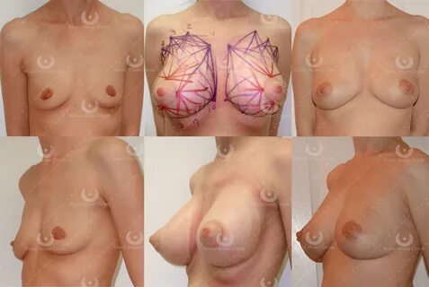 natural breast enhancement with fat transfer patient.