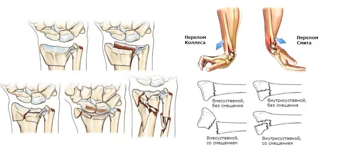 Внутрисуставной перелом лучевой кости. Перелом сустава лучевой кости. Внутрисуставной перелом луча в типичном месте. Рука перелом дистального метаэпифиза лучевой кости.