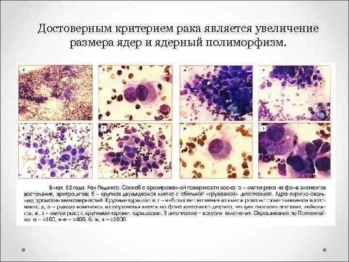 Клетки Педжета цитология. Ядерный полиморфизм клеток что это. Умеренная атипия клеток что. Полиморфизм опухолевых клеток. Клетки с гиперхромными ядрами