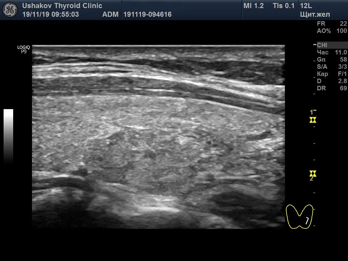 Ti-rads 1. Ti-rads 1 щитовидной железы. Ti rads УЗИ. Ti rads 3. Ti rads 3 в щитовидной