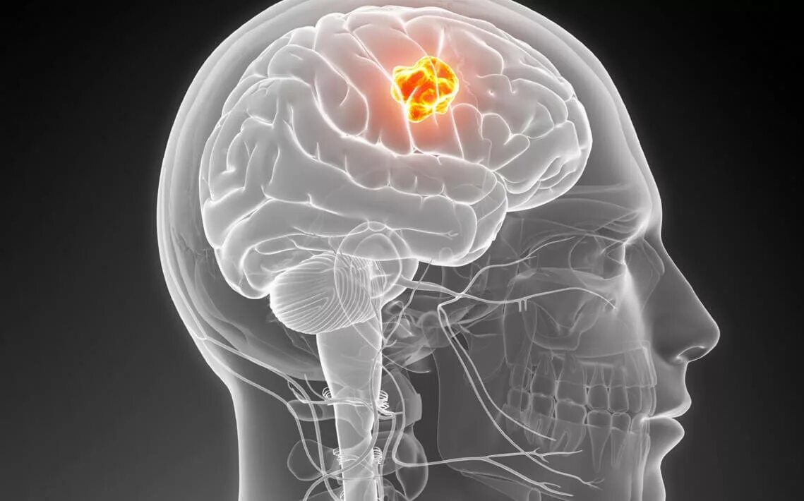 Раковые заболевания головного мозга. Опухоль коры головного мозга. Опухолевые заболевания головного мозга. Опухоль головного мозга отек