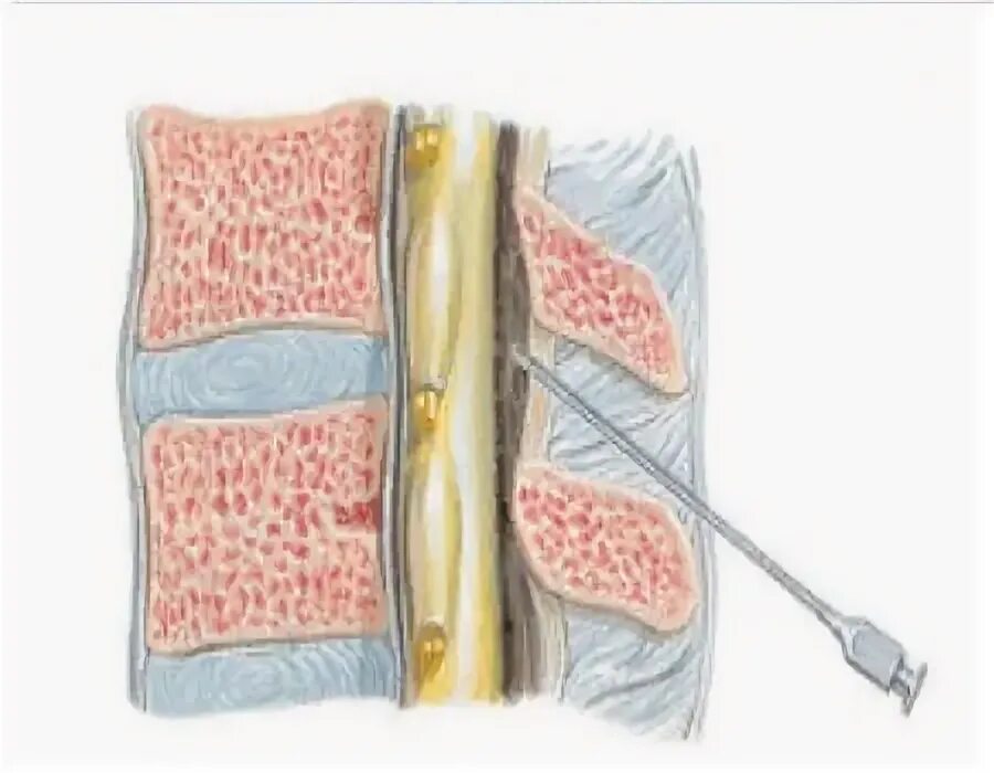 Блокада грыжи цена. Интраламинарная эпидуральная блокада. Трансфораминальная эпидуральная блокада. Эпидуральная блокада грыжи. Эпидуральная анестезия игла.