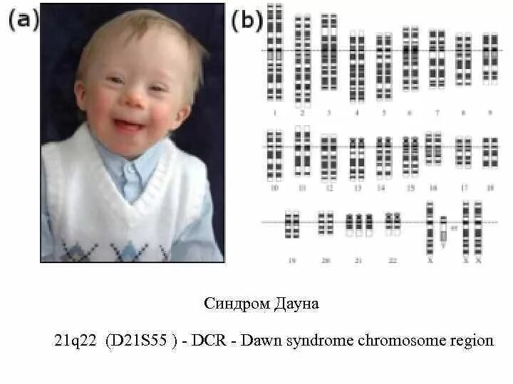Синдром Дауна 21 хромосома. Синдром Дауна трисомия по 21 хромосоме. Хромосомы при синдроме Дауна. Сколько хромосом у даунов.