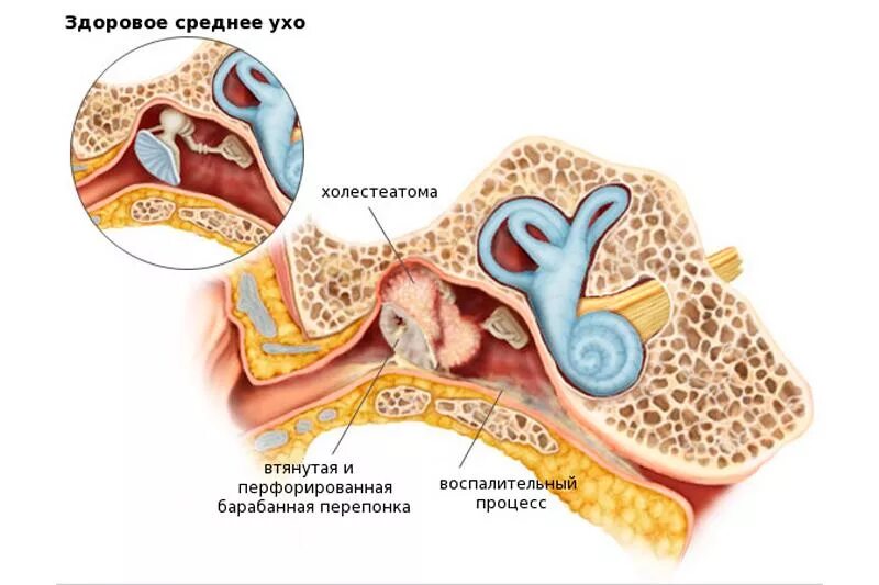 Изменение в среднем ухе. Мезотимпанит барабанная перепонка. Холестеатома слуховых косточек. Холестеатома эпитимпанума. Холестеатома среднего уха на кт.