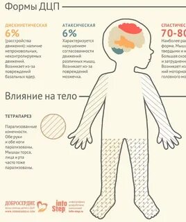 Клинические формы дцп