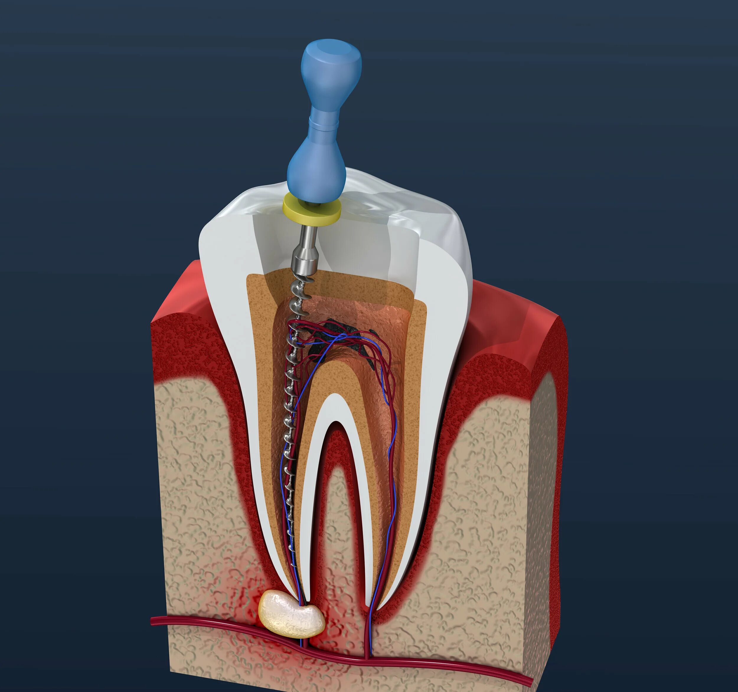 Root canal