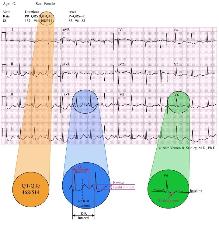 Qt Базетта. ECG course.