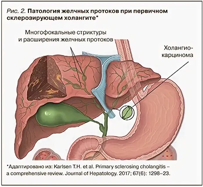 Симптомы забитых желчных протоков. Сужение желчного протока. Стриктуры желчных протоков. Стриктура желчного протока. Рубцовые стриктуры желчных протоков.