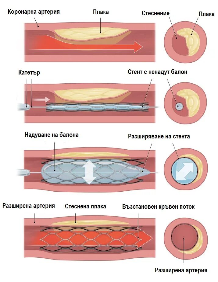 Стент периферический. Стент для коронарных артерий. Как ставят стент