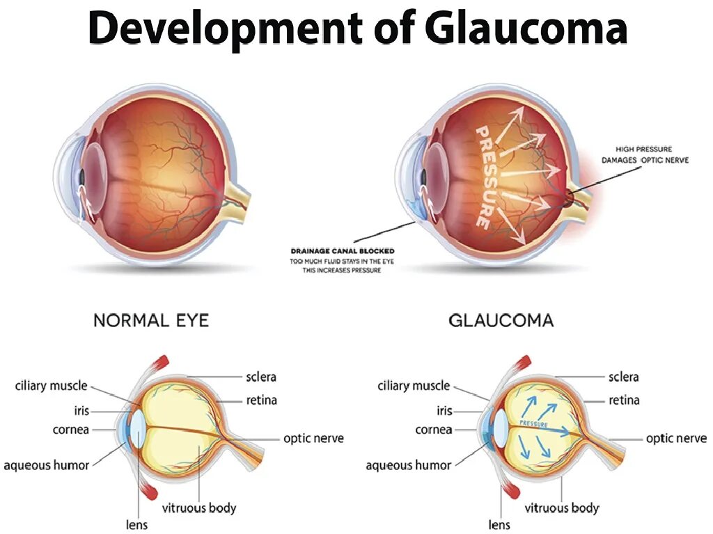 Заболевание глаз глаукома. Глаукома схема. Глаукома латынь