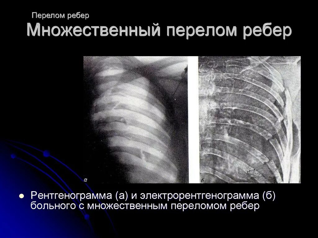 Перелом ребер справа рентген. Флотирующий перелом ребер рентген. Множественный перелом ребер пневмоторакс. Консолидированные переломы ребер рентген.
