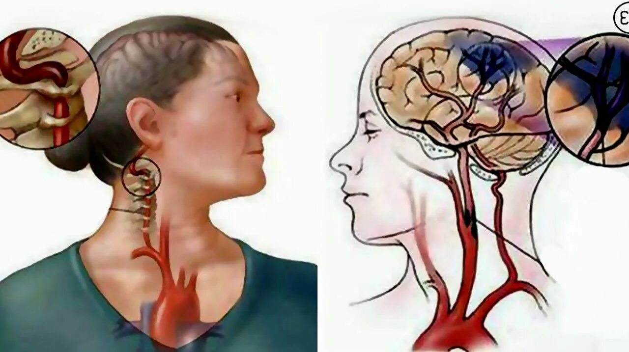 Синдром позвоночной артерии диагноз. Головной мозг после инсульта. Затылочные рога