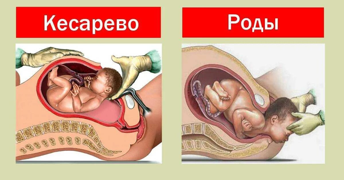 Кесеровое сечение. Естественные родовые пути. Рождение ребенка кесарево сечение.