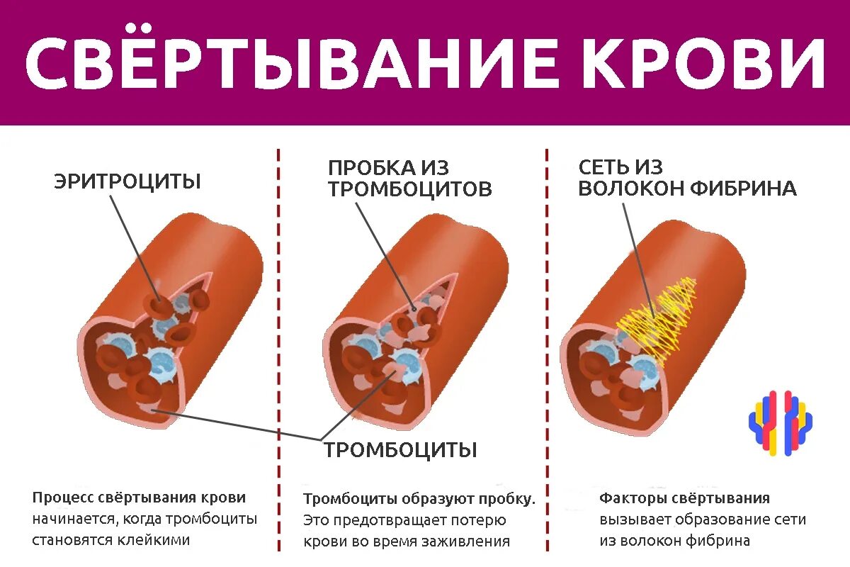 Образование тромба из фибрина