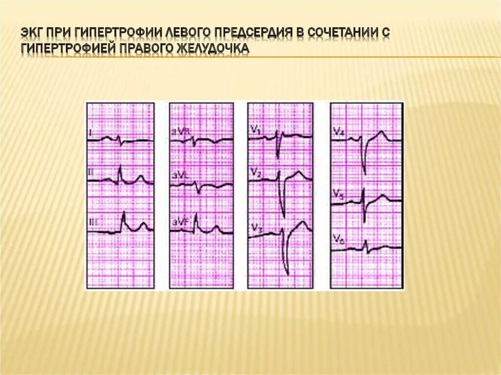 Признаки гипертрофии миокарда на ЭКГ. Гипертрофия правого желудочка на ЭКГ. ЭКГ при гипертрофии правого желудочка. ЭКГ при гипертрофии миокарда. Гипертрофия левого предсердия левого желудочка