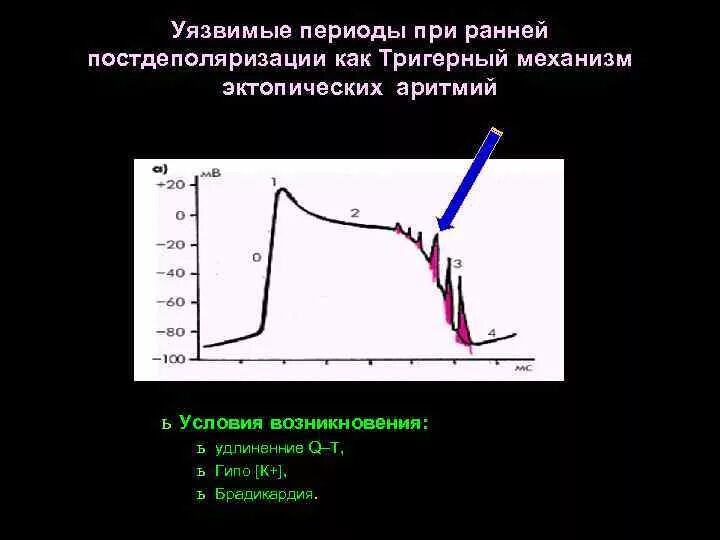 Ранние постдеполяризации. Механизм ранней постдеполяризации. Аритмии механизм возникновения эктопическая.