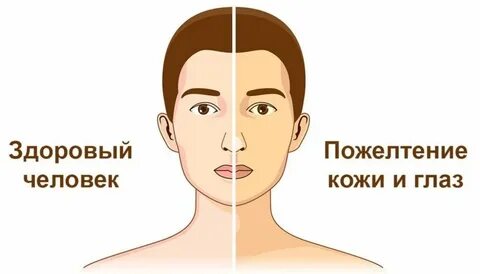 Жильбер болезнь у мужчин