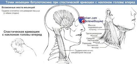 Грудино ключично сосцевидная мышца массаж
