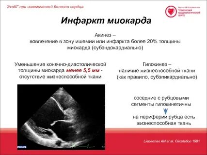 Узи миокарда