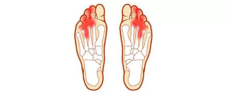 Невринома Мортона стопы. Неврома Мортона мизинец. Невринома Мортона левой стопы. Почему болит палец на правой ноге